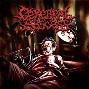 Cerebral Abscess - Cerebral Abscess flac